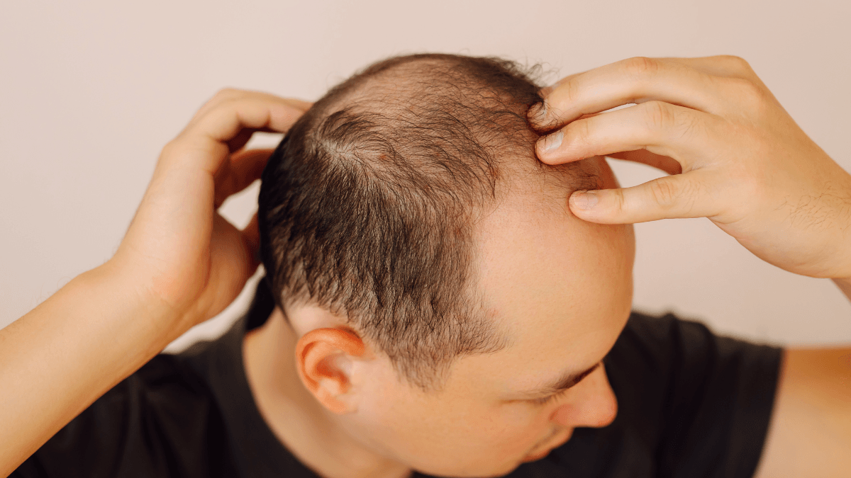 Metformin and Hair Loss