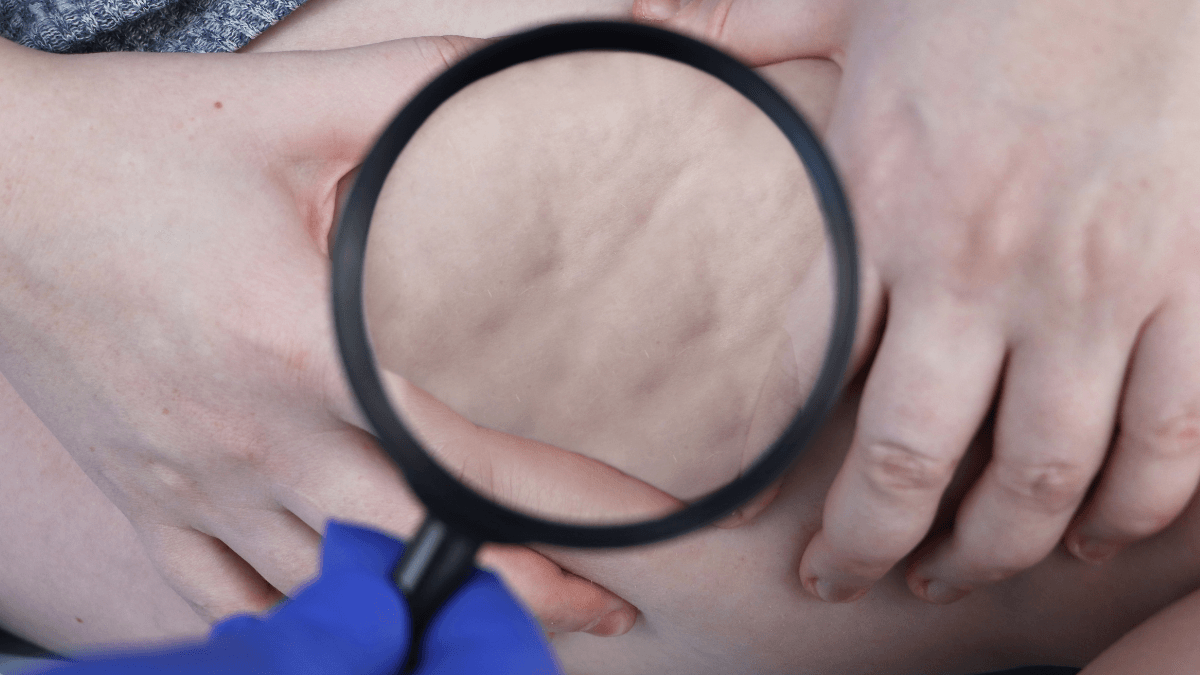 Lipodystrophy