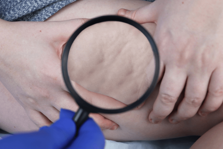 Lipodystrophy