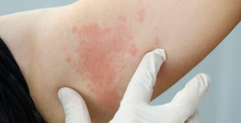 Diabetes Skin Problems: Rashes, Itching, and Warning Signs