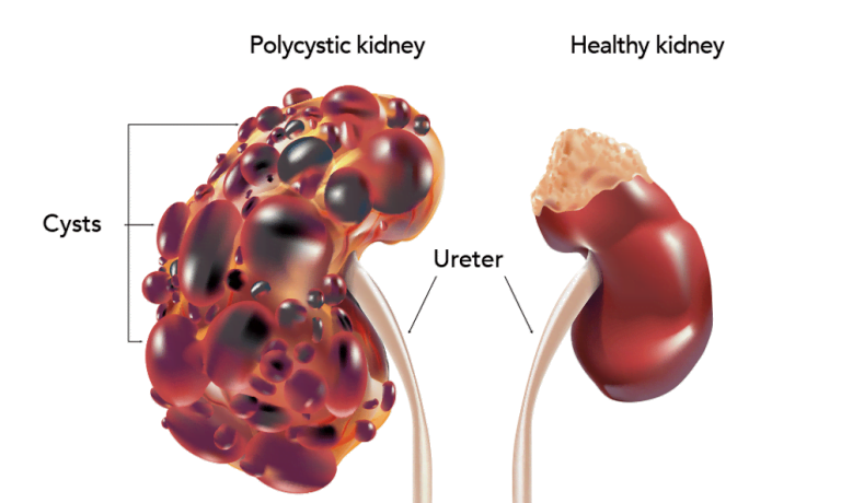 Diabetic Kidney Disease: Symptoms, Stages, and Care