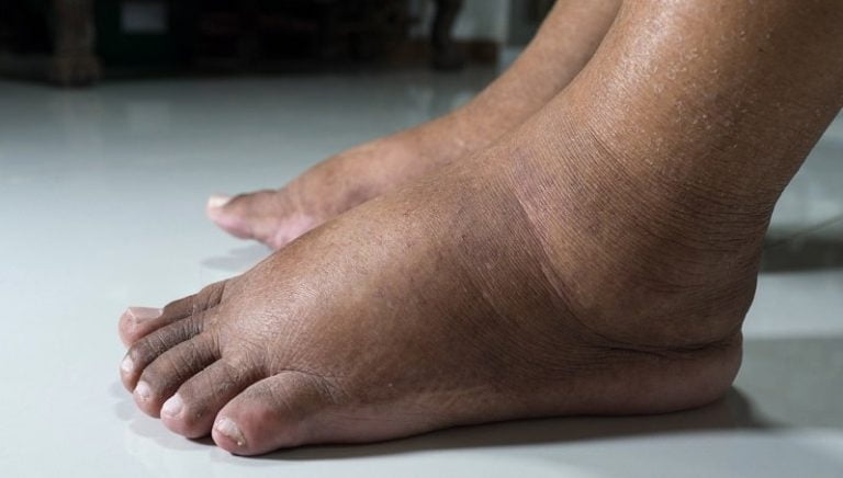 Diabetes Swollen Feet: Symptoms, Causes, and Treatment