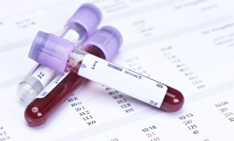 Fasting Plasma Glucose Test: Ranges, Prep, and Results