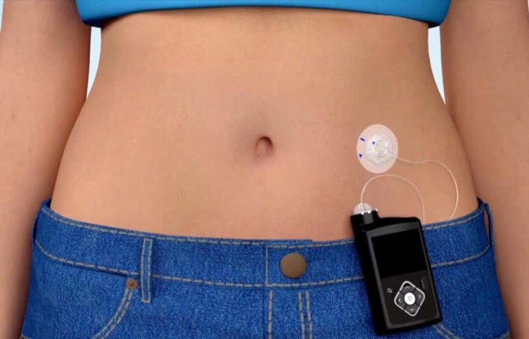 Insulin Pump Explained: How It Works, Types, and Daily Use