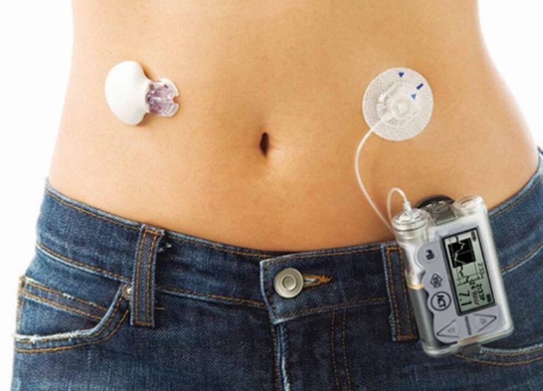 Artificial Pancreas Systems for Diabetes Control and Access